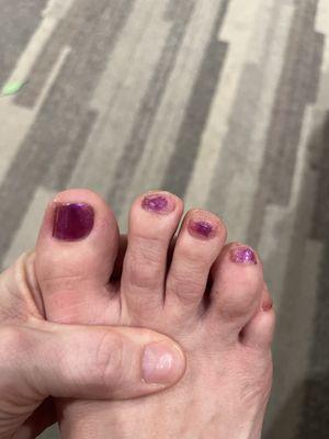 Bad pedicure