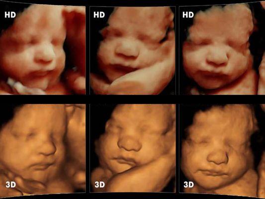 3D 4D Ultrasound by 4D Special Delivery