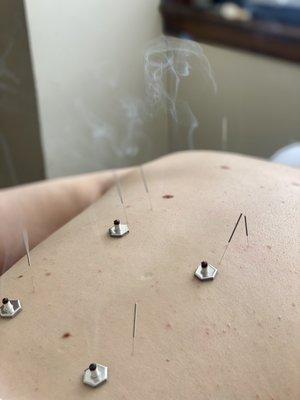 Acupuncture and Moxibustion (Moxa)