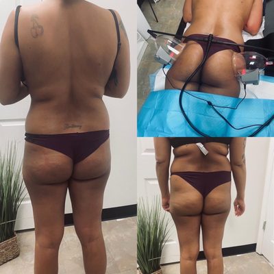 Butt and Hip enhancement