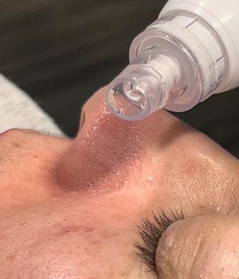 Hydro facial deeply cleanses and removes all impurities