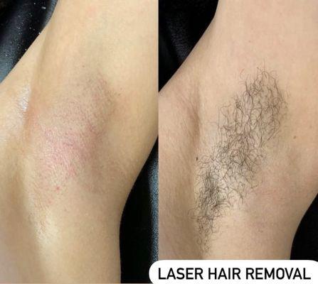 Laser Hair Removal