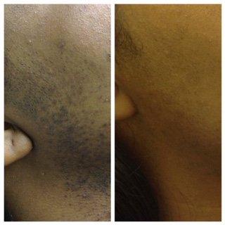 Successful laser hair removal treatment for ALL skin types!