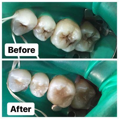 Composite "white" fillings