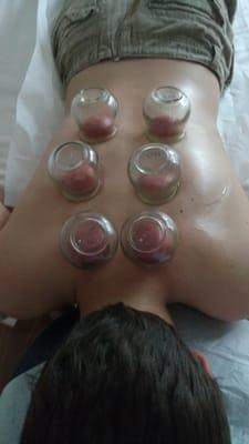 Cupping Therapy for Pain, Immune System ...By Dr. Sonbol