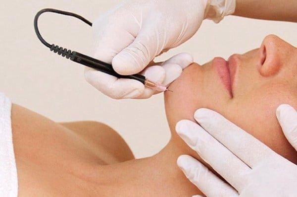 Electrolysis on unwanted chin hair.