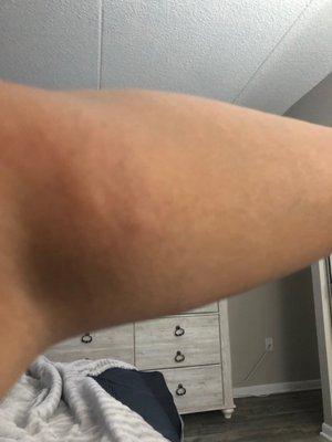 Something bit me on my arm