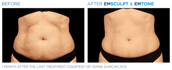 Flatten your abdomen with EMSCULPT / EMTONE