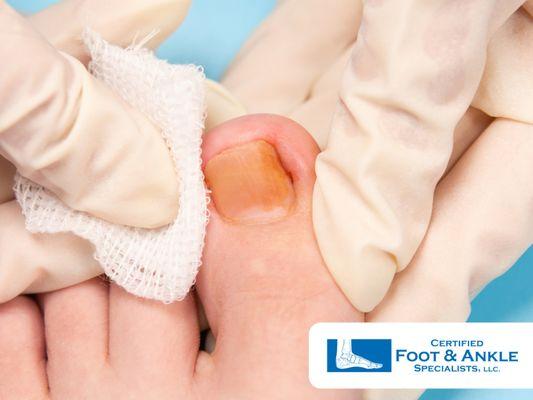 Infected Ingrown Toenail Treatment