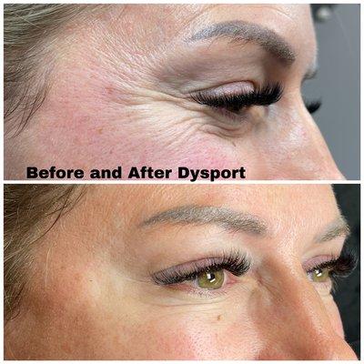 Dysport injections