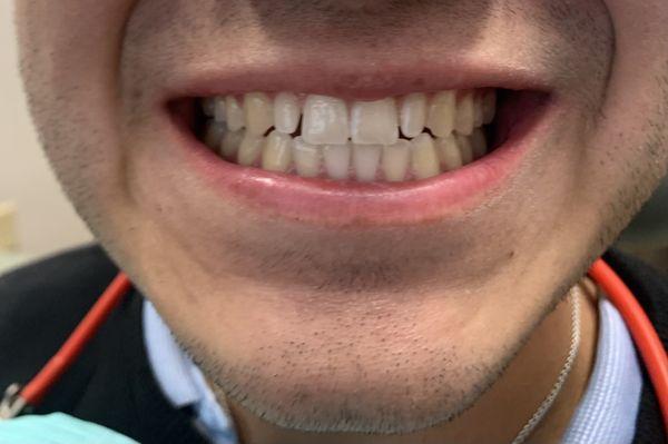 Before composite veneers