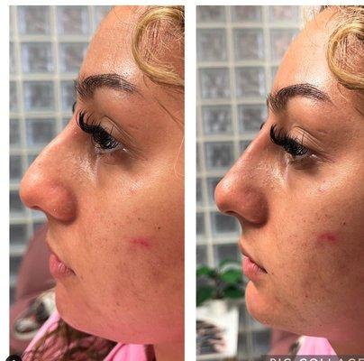 Non surgical nose job with filler