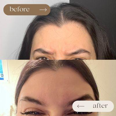 Smooth and refreshed with a touch of Botox! Check out this subtle yet powerful before-and-after!