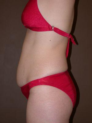 34 y/o woman before abdominoplasty.