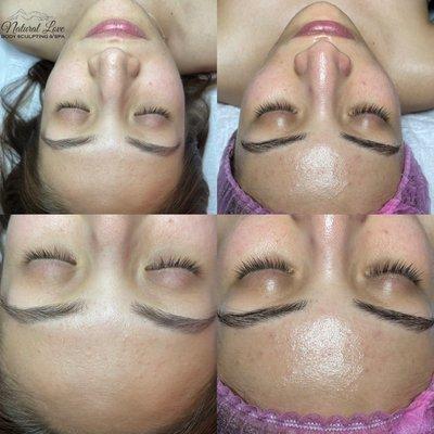 Deep cleaning & hydrating facial