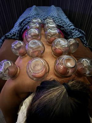 Fire cupping