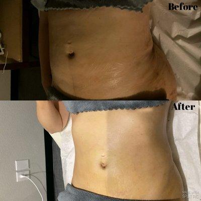 Before and after 1 lymphatic drainage treatment.