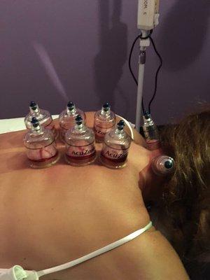 Cupping