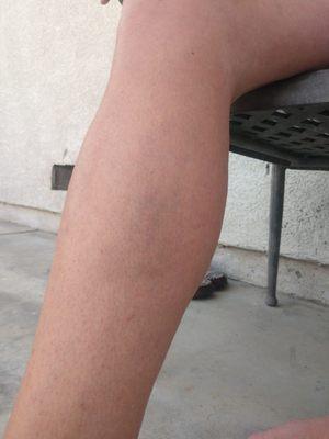 Bruise on my wife's leg