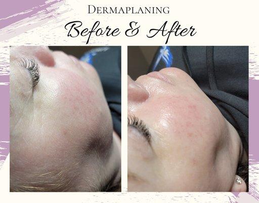 Dermaplane before and after only $40