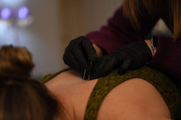 Dry Needling is a method that targets muscle knots or "trigger points" that cause discomfort or restrict mobility.