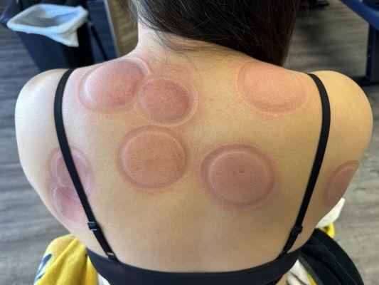 Dry cupping = immediate pain relief