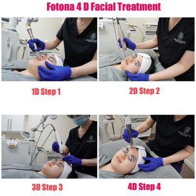 Fotona 4 D treatment: 4 steps