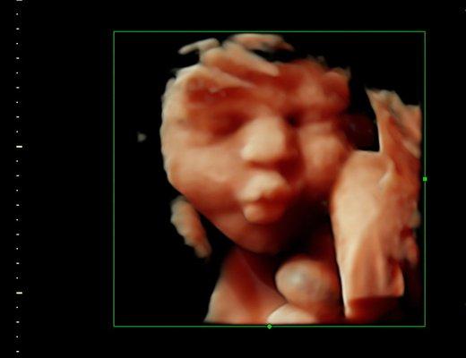 3D/4D HDlive ultrasound image showing a baby blowing kisses and making a sweet face.