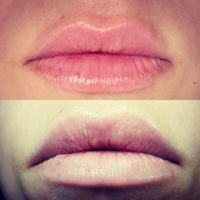 Needle free lip filler