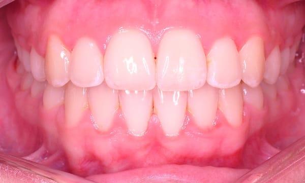 Wang Orthodontic Patient "B" After