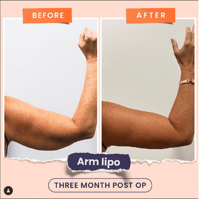 Arm Lipo 3 month post-op