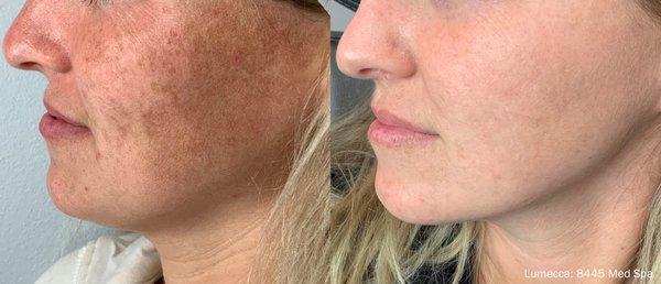 Lumecca IPL Laser 
 
Skin Resurfacing, age spots, rosacea, sun damage, freckles and vascular/spider veins. Clear beautiful skin.