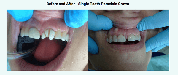 Single Tooth Porcelain Crown