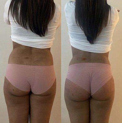 One session/same day results after Lipo Cavitation/laser lipo on the waist area and Non-Surgical Buttocks lift. Photos taken 1.5 hours apart