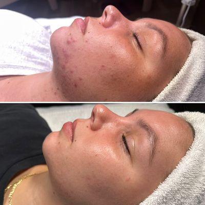 Acne Program results