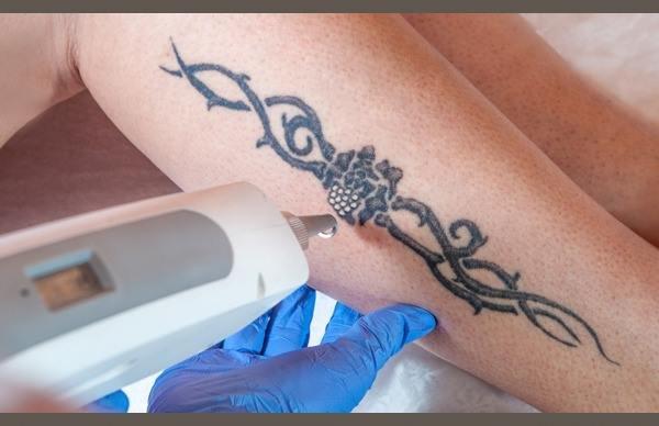 Time and priorities change. So can tattoos. Our Laser Tattoo Removal treatment is the best option to remove the regret.