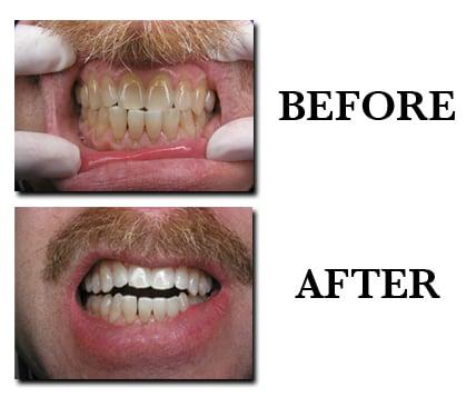 Dental Bleaching