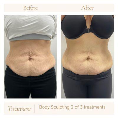 Ultrasound cavitation along with radio frequency and laser lipo- Body Sculpting package.