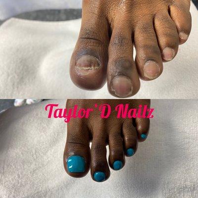 Toenail Restoration with waterless pedicure.