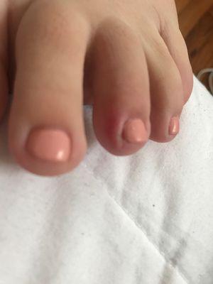 My friend's toe. Great pedicure but I would recommend they wash their tools regularly.