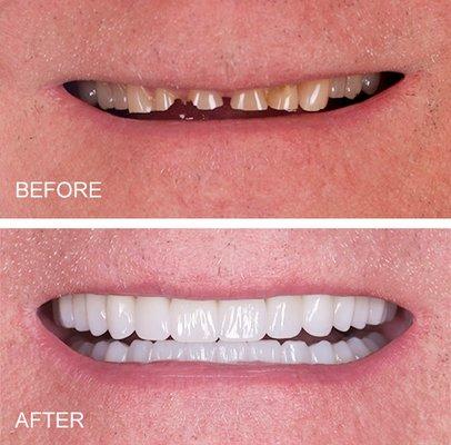 Full mouth rehabilitation using all ceramic crowns to restore function and esthetics.