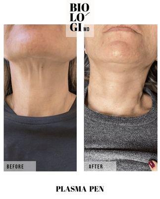 Neck Tightening