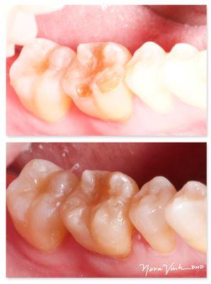 Worn down enamel exposes the soft layers underneath - causes sensitivity and pain. Restored conservatively with bonded composites.