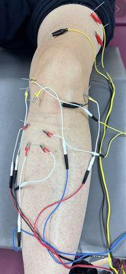 Electrical dry needling for knee pain