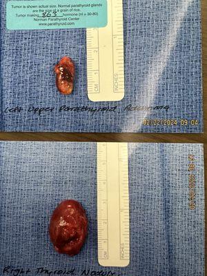 Thyroid nodule and parathyroid gland.