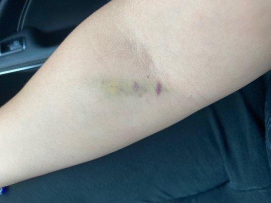 Blood work bruising