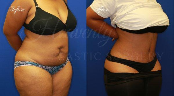 Tummy Tuck (Abdominoplasty) with Liposuction