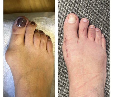 Before and after bunion surgery and correction of 2nd and 3rd hammertoes