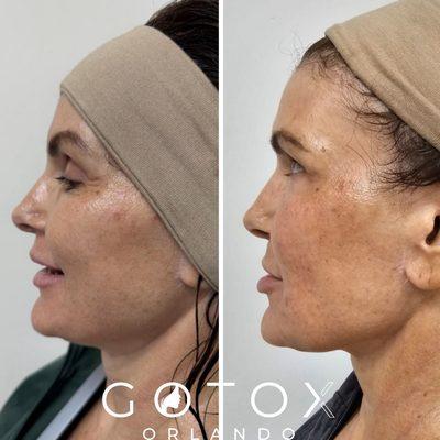 Look at that jawline sculpting. These photos are 30 days apart, after 1 Morpheus8 treatment.