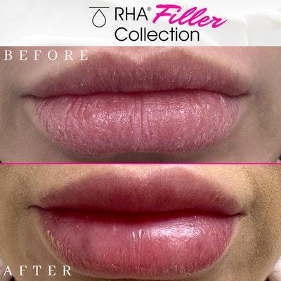 Before and after lip filler